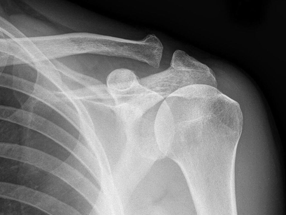 arthrose de l'articulation de l'épaule sur ma radiographie
