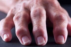 Les principales différences d'arthrite et d'arthrose